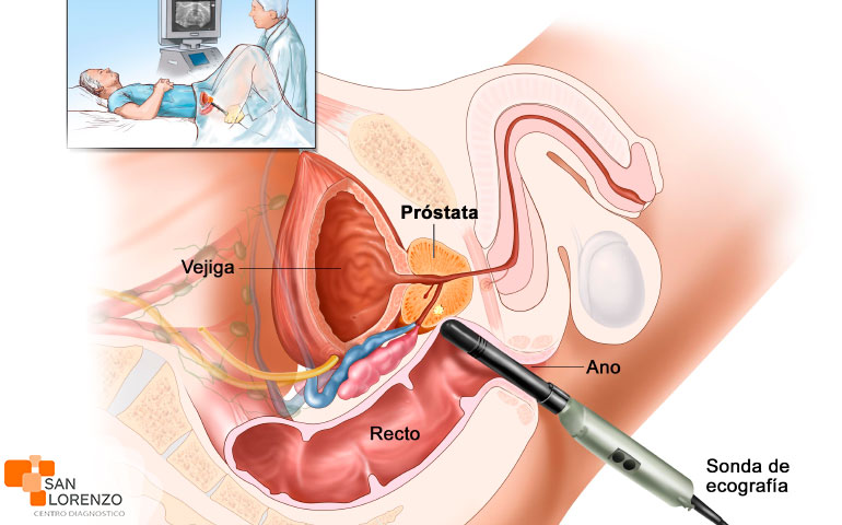 Neuroendocrine cancer breakthrough, Neuroendocrine cancer of prostate