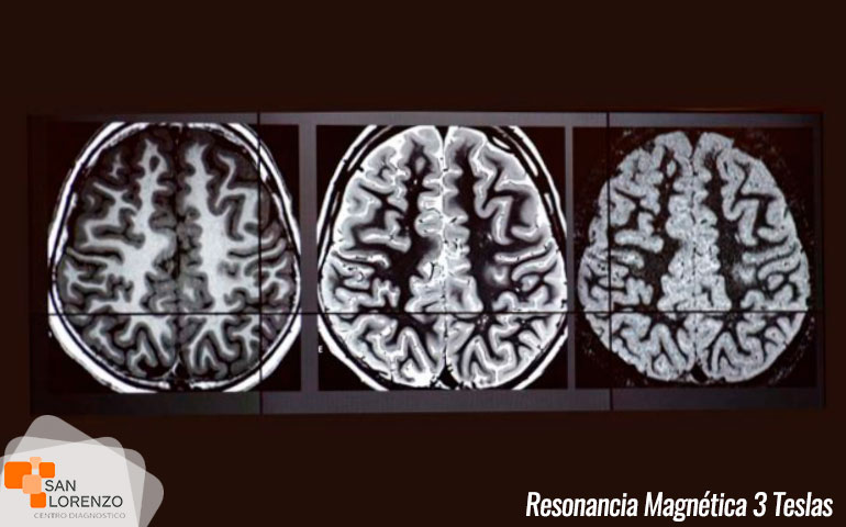 Diferencias-entre-R.M1.5T-y-R.M3T